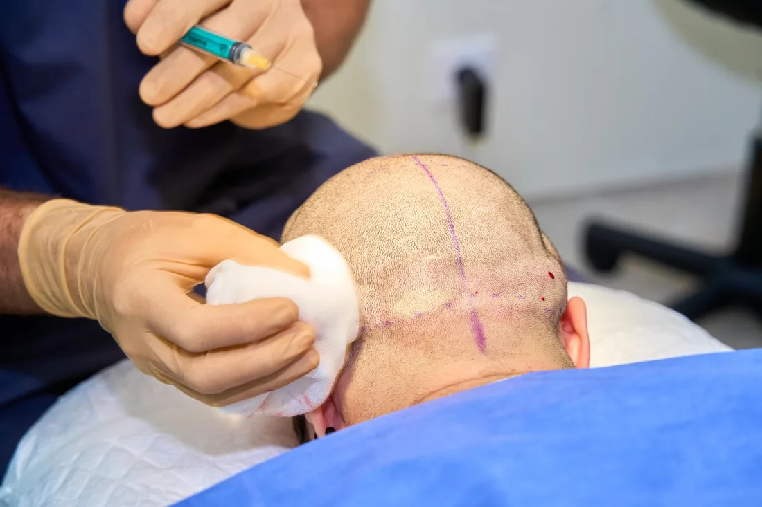 PRP therapy performed at Golden Touch
