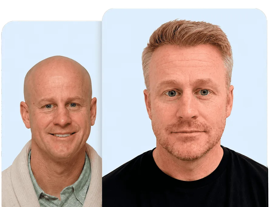 Before and after hair restoration