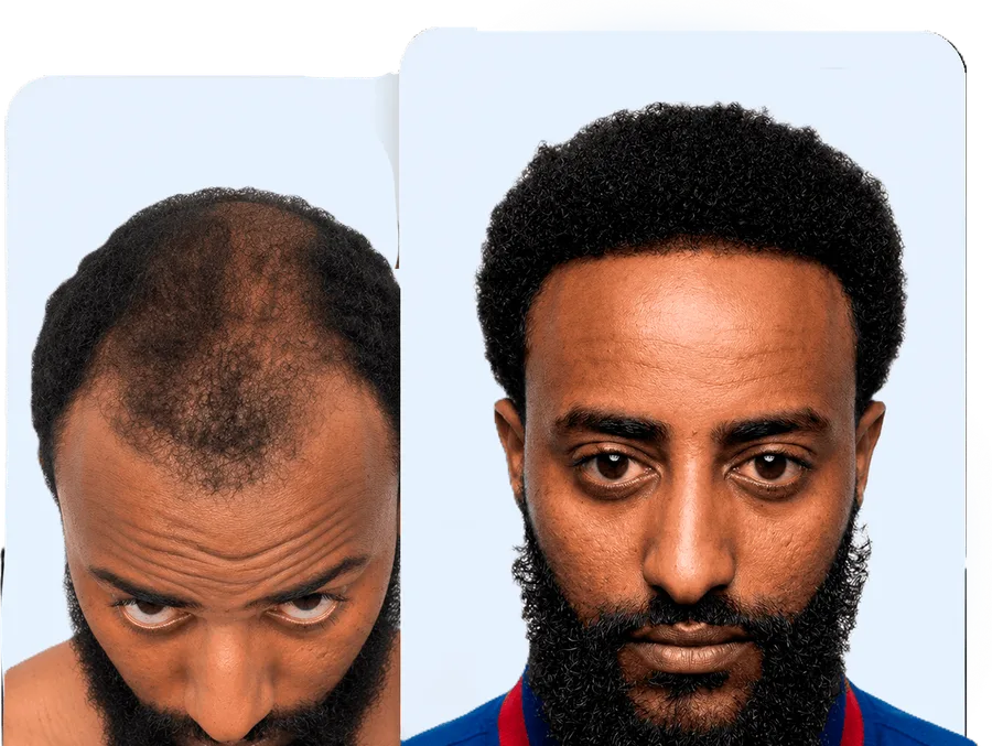 Before and after — Restauración de línea capilar