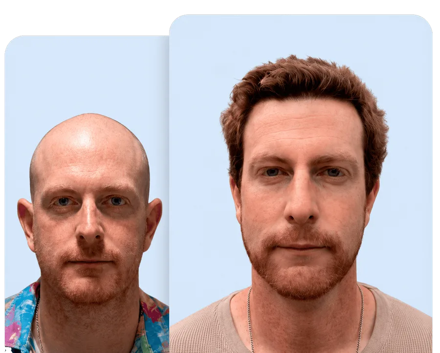 Before and after hair restoration