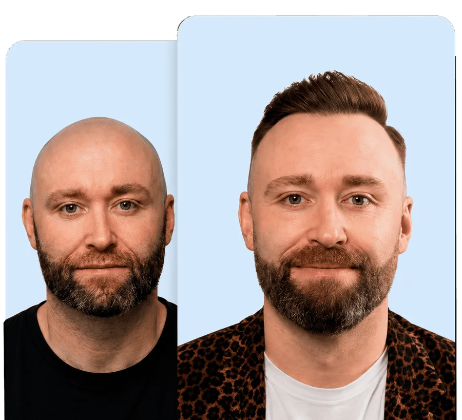 Before and after — Línea capilar y densidad