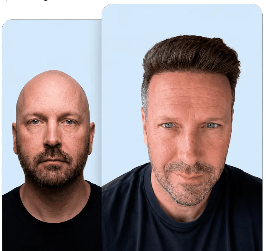Before and after — Línea capilar frontal